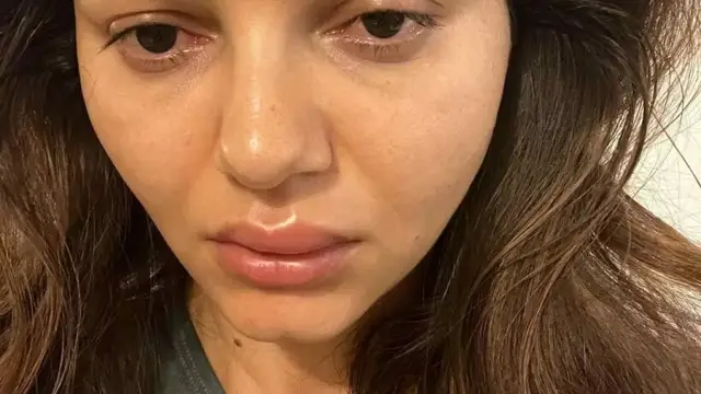 Rubina Dilaik के चेहरे का हुआ बुरा हाल, सूजी आंखें देख हैरान हुए फैंस